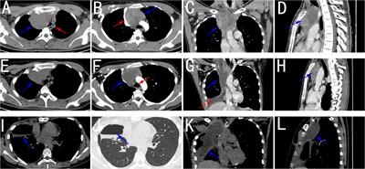 A Case report: Synovial sarcoma of the mediastinum in an 18-year-old teenager